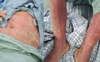 Triển khai các hoạt động điều tra, giám sát, phòng chống bệnh liên cầu lợn trên người