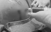 Hút 1,5 lít dịch mủ cứu bệnh nhân thoát nguy kịch do áp xe gan