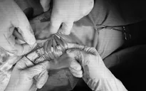 Em bé có 5 vòng dây rốn quấn cổ "hiếm gặp" chào đời an toàn