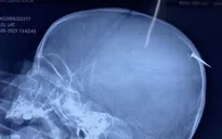 Phẫu thuật kịp thời cho bé trai bị cây đinh dài 3cm đâm qua xương sọ