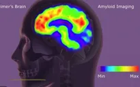 Thuốc Donanemab làm chậm sự tiến triển của bệnh Alzheimer
