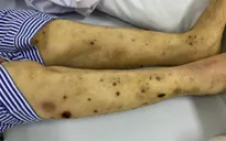Mời thầy lang dùng ong châm trị đau chân tay, bệnh nhân đái tháo đường phải nhập viện vì đa biến chứng