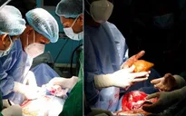 Phẫu thuật lấy viên sỏi thận lớn nhất thế giới từ một quân nhân về hưu
