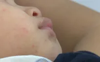 Cần chủ động phòng ngừa khi bệnh tay chân miệng có chiều hướng gia tăng