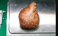 Thành công loại bỏ cục sỏi thận lớn nhất thế giới có kích thước bằng...quả bưởi
