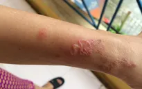 Cảnh báo nhiễm ký sinh trùng từ chó, mèo