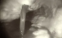 Cảnh báo tình trạng xuất huyết tiêu hóa do dùng nhiều bia rượu