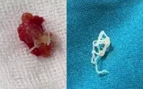 Phát hiện ca bệnh giun chỉ ký sinh tại Phú Thọ