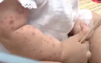 TP. Hồ Chí Minh: Xác định nguyên nhân gây bệnh tay chân miệng nặng ở trẻ em