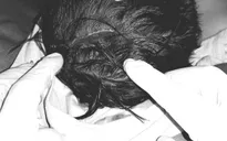 Bé trai 18 tháng tuổi bị chó cắn lộ xương sọ