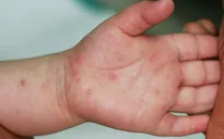 Gia tăng bệnh nhi mắc tay chân miệng ở ĐBSCL