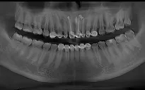 Nang xương hàm do bọc răng thẩm mỹ