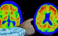 Thêm loại thuốc hứa hẹn làm chậm quá trình Alzheimer