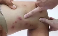 Gia tăng bệnh nhân nhiễm độc kiến ba khoang