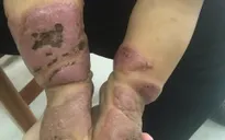 Người nhà tự ý sử dụng lá cây điều trị viêm da cơ địa, bệnh nhi 11 tháng tuổi bị hoại tử nặng nề