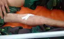 Nam bệnh nhân nguy kịch do nhiễm khuẩn huyết não mô cầu