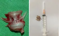Nội soi gắp mảnh xương cá lớn cắm sâu trong thực quản người bệnh