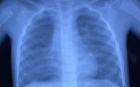 Bé 5 tuổi bị ngộ độc do uống nhầm chất tẩy rửa