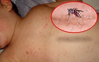 Nguy hiểm: Bé sơ sinh 7 ngày tuổi đã mắc sốt xuất huyết