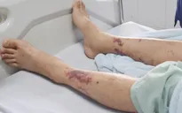 Cảnh báo nguy cơ tử vong do nhiễm liên cầu lợn