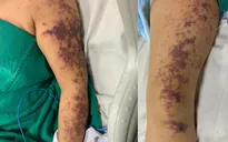 Người phụ nữ mắc liên cầu khuẩn sau khi ăn lòng lợn