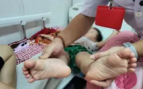 Đắk Lắk: Gần 1.200 ca mắc, 3 ca tử vong do tay chân miệng