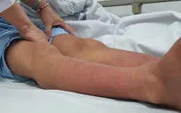 Cảnh báo nguy kịch do tự điều trị sốt xuất huyết tại nhà