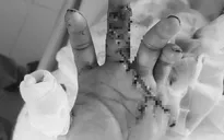 Trả lại bàn tay lành lặn cho bệnh nhân bị đứt lìa 2 ngón tay