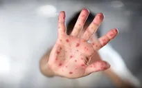 Đồng Nai ghi nhận ca bệnh đậu mùa khỉ đầu tiên