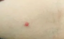 Bộ Y tế: Tăng cường điều trị ca mắc đậu mùa khỉ, không để xảy ra lây nhiễm chéo