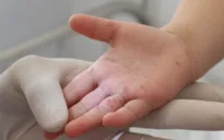 Trẻ mắc tay chân miệng tăng đột biến tại Hải Dương