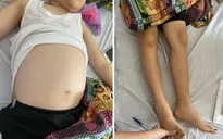 Tự ý ngừng điều trị hội chứng thận hư, bé trai suýt nguy kịch