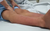 Người bệnh đái tháo đường mắc sốt xuất huyết nguy hiểm gấp nhiều lần