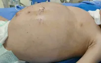 Bé 2 tuổi nguy kịch do gia đình tự điều trị bệnh thận tại nhà