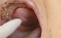 Cắt bỏ khối u hiếm gặp trong vòm miệng bệnh nhân suốt hơn 10 năm