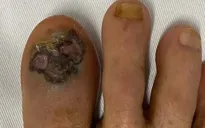 Mắc ung thư tế bào hắc tố sau khi xuất hiện mảng đen ở ngón chân