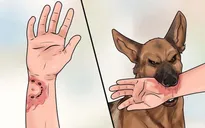 Không tiêm phòng dại, người đàn ông phát bệnh sau 2 tháng bị chó cắn