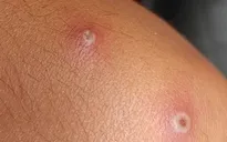 Cà Mau thông tin về ca mắc đậu mùa khỉ đầu tiên