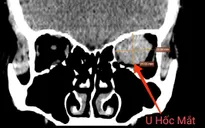 Giảm thị lực, lồi mắt vì khối u hốc mắt
