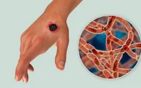 Thái Lan kêu gọi người dân cảnh giác với bệnh than