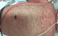 Bộ Y tế đề nghị các địa phương tăng cường công tác phòng chống bệnh sởi