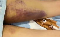Bình Thuận: Một phụ nữ kêu cứu bị chồng cũ hành hạ gây thương tích