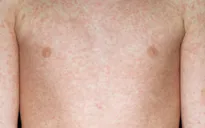 WHO cảnh báo số ca mắc sởi gia tăng trở lại ở châu Âu