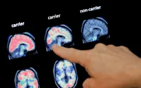 Trí tuệ nhân tạo giúp phát hiện sớm bệnh Alzheimer