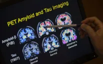 Phương pháp xét nghiệm máu giúp chẩn đoán bệnh Alzheimer nhanh và chính xác hơn