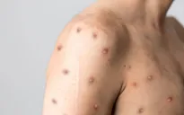 WHO họp khẩn về sự lây lan của bệnh đậu mùa khỉ