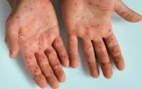 Phát hiện ca bệnh đậu mùa khỉ đầu tiên ngoài châu Phi