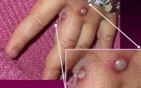 GAVI tài trợ 500 triệu USD cho vaccine phòng bệnh đậu mùa khỉ