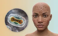 Cần hiểu rõ các mô hình lây nhiễm đậu mùa khỉ