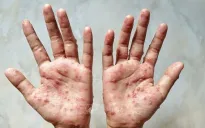 Châu Âu nâng cảnh báo rủi ro đối với bệnh đậu mùa khỉ